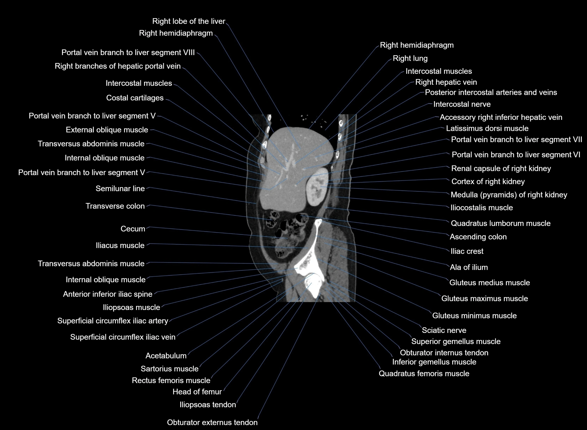CT Abdomen sagittal cross sectional anatomy labelled radiology image -00087.webp